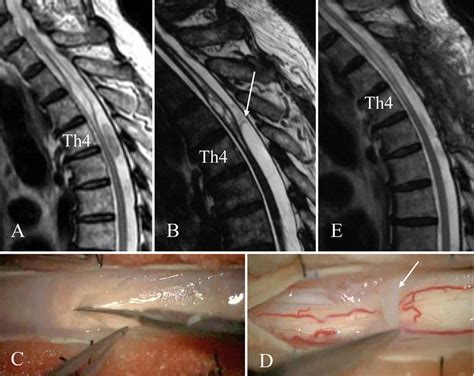 Pre And Postoperative Mri Findings Of The Thoracic Spine And