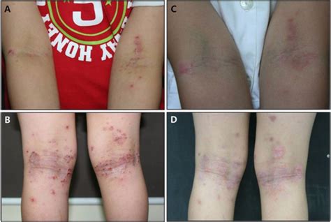 A B Erythematous Plaques And Papules With Excoriation And Download Scientific Diagram