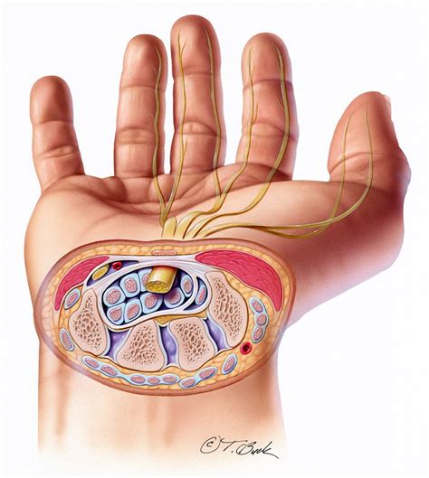 Carpal Tunnel Syndrome Illustration By Todd Buck Medical Illustration