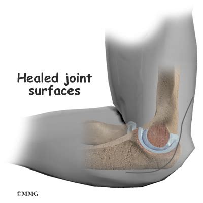 Lower back pain bone sticking out melbourne, hip and leg. Interposition Elbow Arthroplasty | eOrthopod.com