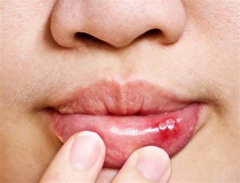 What Is Blood Blister In Mouth Causes And Treatment Icy Health