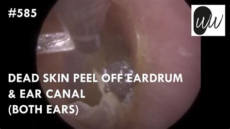 585 Dead Skin Peel Off Eardrum And Ear Canal Both Ears Youtube