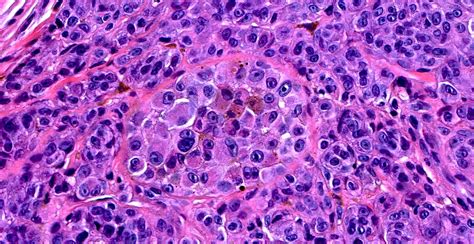 Invasive Melanoma Histology