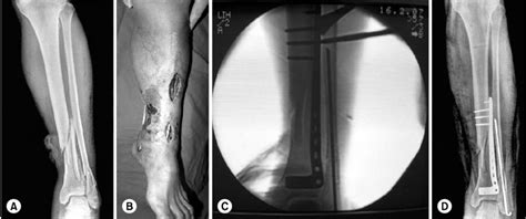 A The Initial Film Shows A Comminuted Fracture Of The Distal Tibia