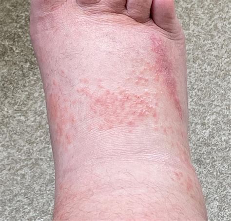 Little Red Bumps On Feet