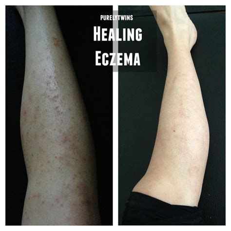 Heal Eczema Dorothee Padraig South West Skin Health Care
