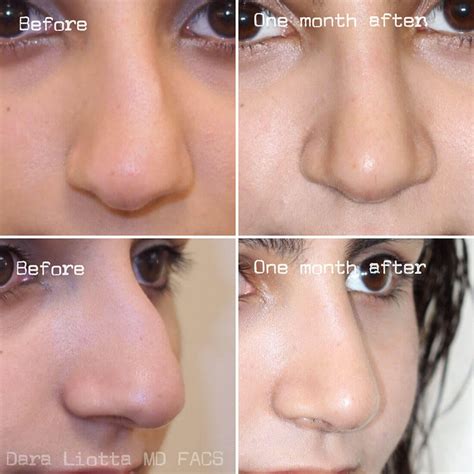 Rhinoplasty Archives Dr Dara Liotta