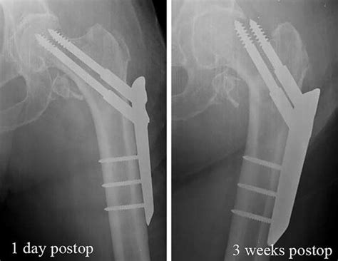 Cut Out In Osteosynthesized Intertrochanteric Hip Fracture With Pccp At