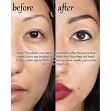 Permanent Makeup Removal Laser