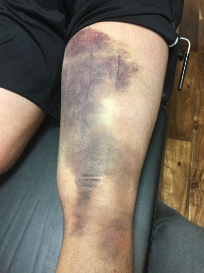 Pulled Hamstring Bruise
