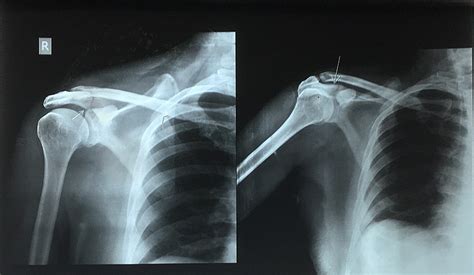 Cureus Isolated Fracture Of The Acromion Process A Case Report