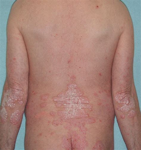 Psoriasis Epidemiology Clinical Features And Quality Of Life