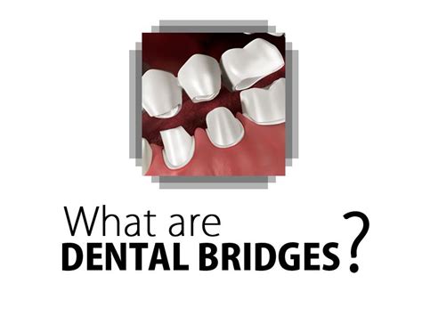 Dental Bridges Are Replacements To Lost Teeth They Essentially Bridge