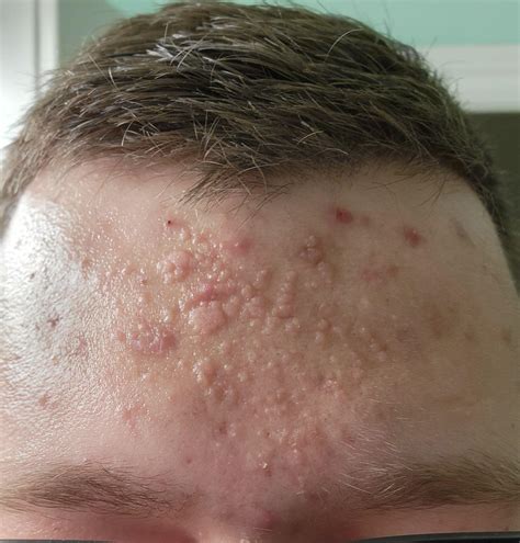 25 M Flat Warts On Forehead Has Been Like This For Years Has