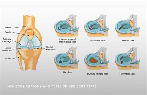 Meniscus Tear Schaumburg Il Thomas Obermeyer Md