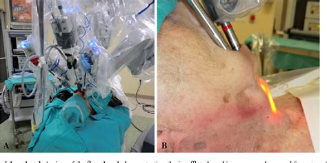 Pdf Transoral Robotic Assisted Thyroidectomy With Central Neck