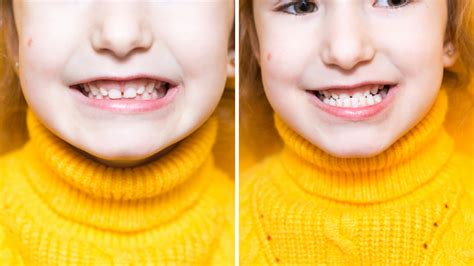 Underbite Vs Overbite And What You Should Know About Treatments