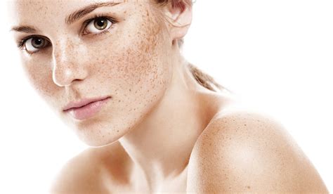 What Causes Freckles