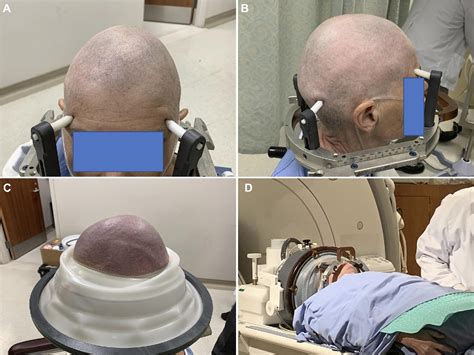 Magnetic Resonance Guided Focused Ultrasound Capsulotomy For