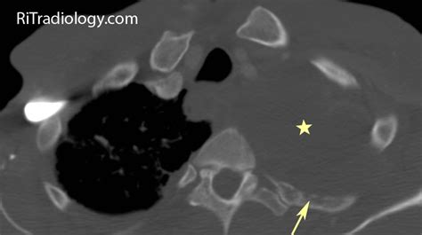 Rit Radiology Lung Cancer Chest Wall And Pleural Invasion