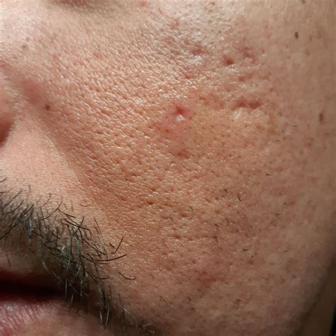 Help Severe Acne Scars Scar Treatments