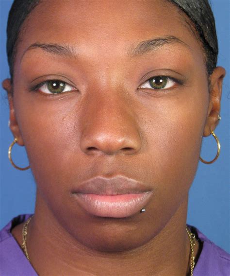 African American Ethnic Rhinoplasty Cosmetic Nose Surgery By Dr