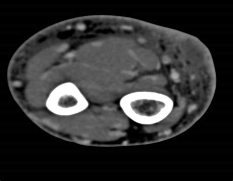 Cellulitis With Small Focal Abscess Musculoskeletal Case Studies