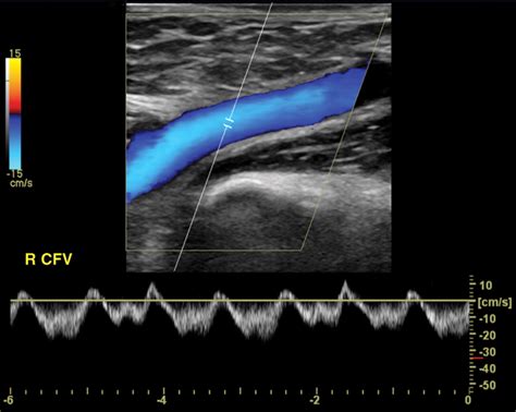 Venous Doppler Sonography Of The Extremities A Window To Pathology Of The Thorax Abdomen And