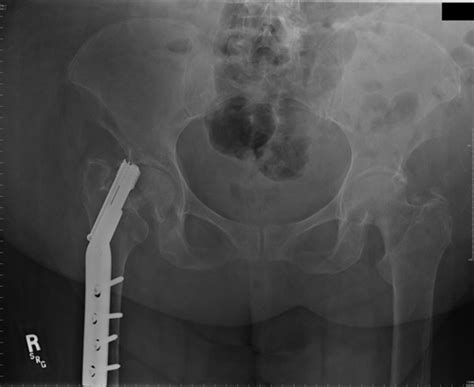 Intertrochanteric Fractures Trauma Orthobullets 4700 The Best Porn