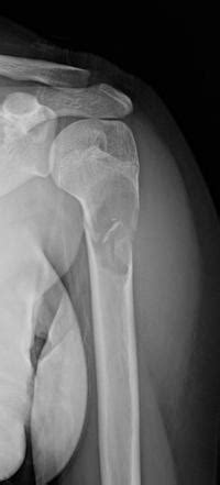 Unicameral Bone Cyst Radiology Reference Article Radiopaedia Org