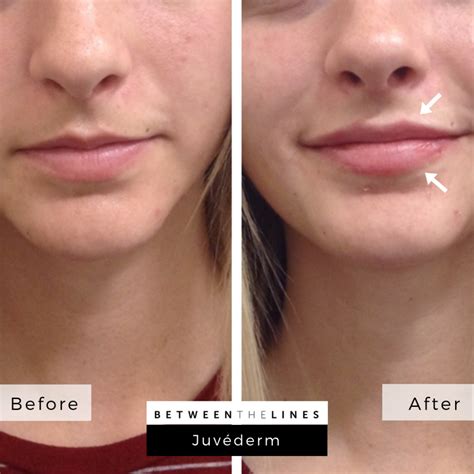 Juvederm Ultra Plus Before And After Lipstick