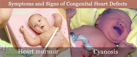 Congenital Heart Defects Causes Symptoms Diagnosis And Treatment