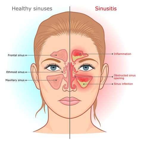 A Sinus Fungal Ball Causes Problems Galore Suzy Cohen Rph Offers Natural Remedies To Help You
