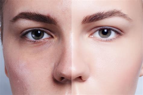 Beauty Skin Care Before And After Comparison Stock Photo 01 Free Download