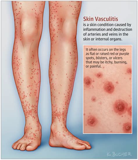 This Patient Page Describes Vasculitis Focusing Especially On Skin Vasculitis How To Recognize