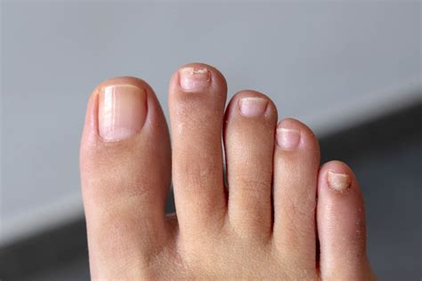 Nail Fungus Causes Symptoms And Treatment Guide Demotix