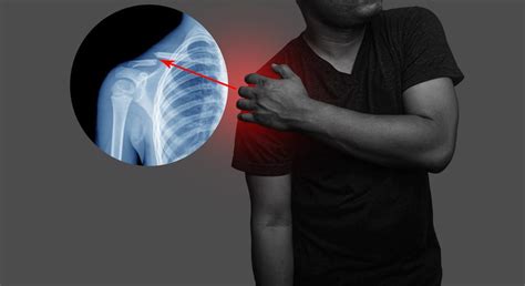 Collarbone Pain Causes And Best Treatment Options In 2024