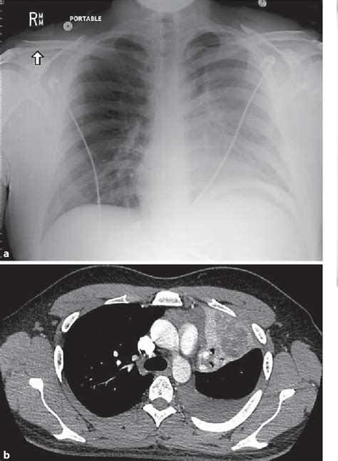 Figure 1 From Eosinophilic Pleural Effusion Complicating Allergic