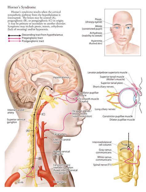 Horners Syndrome Physiopedia