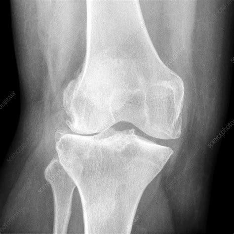 Knee In Osteoarthritis X Ray Stock Image C Science Photo