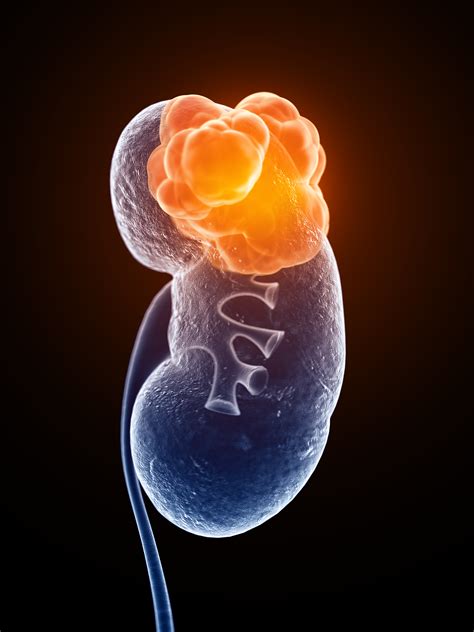 Kidney Cancer As Related To Cancers Pictures
