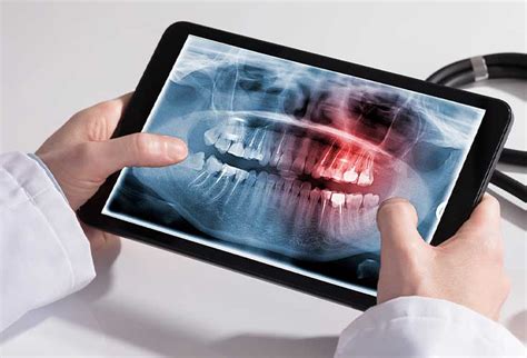 Digital X Rays Detect And Treat Diseases Rochedale Central Dentist