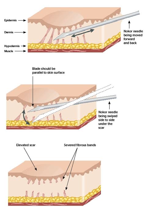 Subcision For Acne Scars Experts Guide To Effective Acne Scar