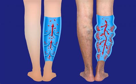 Varicose And Spider Vein Treatments Medicalux