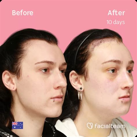 Evelyn Before And After Ffs Surgery — Facialteam