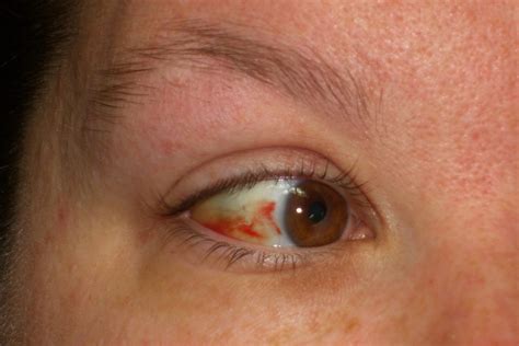 Blood Vessel In Eye Broken Blood Vessel In Eye Pic Babycenter