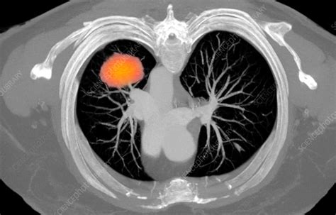 Ct Scan Showing Lung Cancer