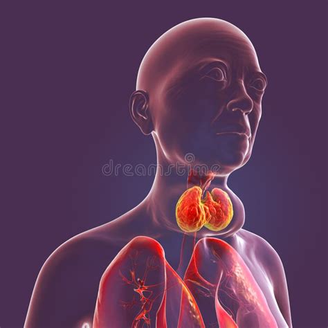 Enlarged Thyroid Gland 3d Illustration Stock Illustration