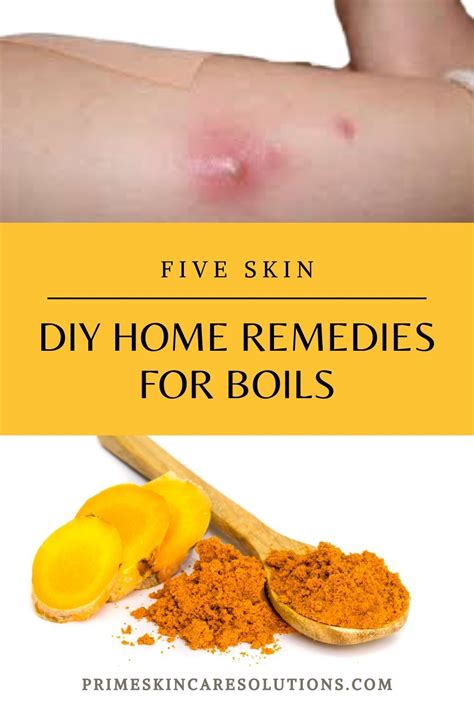 Diy Home Remedies For Boils Home Remedy For Boils Remedies Natural