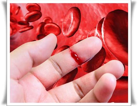 Hemofilie is een zeldzame ziekte van het bloed. Opinii Criza medicamente bolnavi de HEMOFILIE. Tratamentul ...